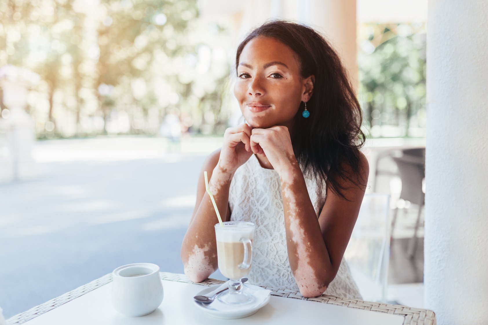 Girl with Vitiligo